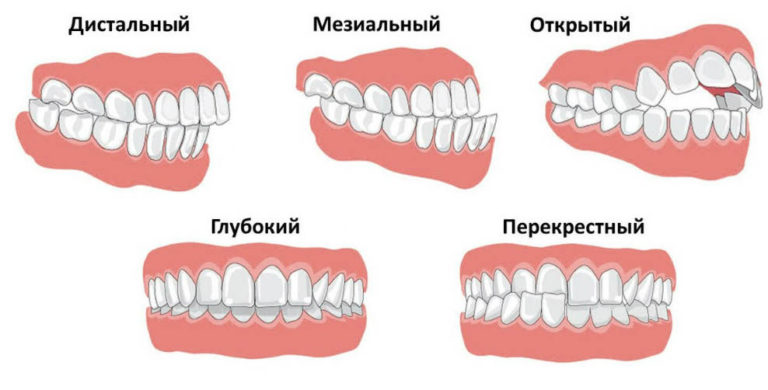 Виды прикуса